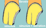 Sinous bevels disguise margins better
