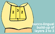 Class II bucco-lingual composite incremental pattern
