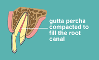 The canal is root filled with gutta percha coated with cement