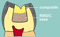 Resin-modified glass-ionomer cement base to reduce bulk of composite