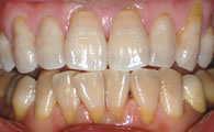 Tetracycline discolouration - 5 years after bleaching upper teeth only