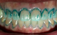 Plaque on teeth disclosed with dye from disclosing tablet