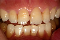 Lost restoration upper right central incisor