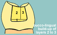ClassII bucco-lingual build-up