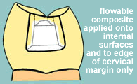 Flowable composite as elastic layer