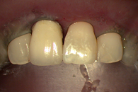 Completed composite restoration upper left central incisor