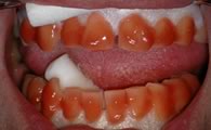 Gums are protected with a barrier (white) then bleach (red) is placed onto the tooth surface