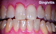 Red gum margins from gingivitis