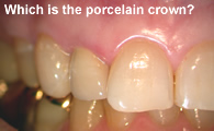 Porcelain/ceramic Crown on Lateral Incisor