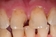 Lost filling upper right central incisor