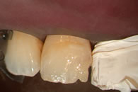 Dentine layer built up with A2 dentine shade
