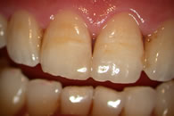 Completed composite restoration upper right central incisor