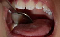 Scrape back of tongue with a spoon